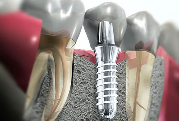 implantologji dentare