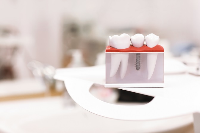 Dentist dental teeth teaching model showing titanium metal tooth implant screw. Generic Dental Implant Study Analysis Crown Bridge Demonstration Teeth Model